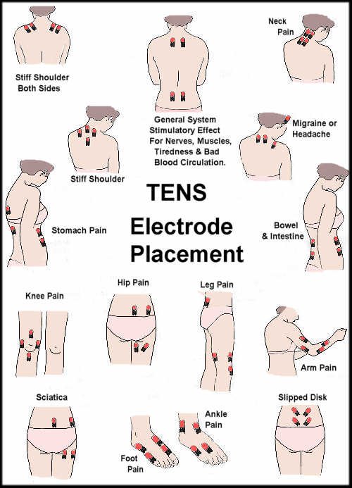 tens-unit-electrode-placement-guide-prohealthcareproducts