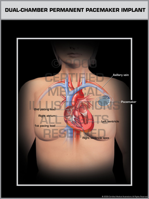 Single chamber icd implant cpt code