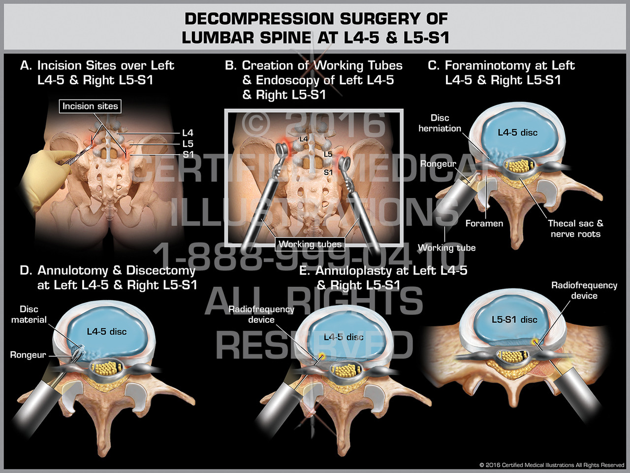 Decompression Surgery Of Lumbar Spine At L4