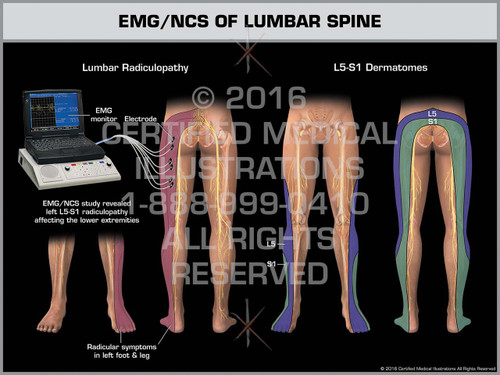 emg test lumbar spine