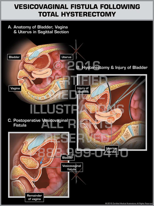 Vesicovaginal Fistula Following Total Hysterectomy