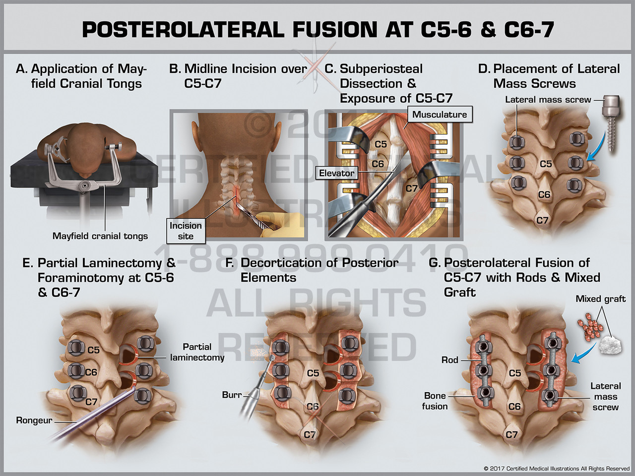 Posterolateral Fusion at C5-6 & C6-7