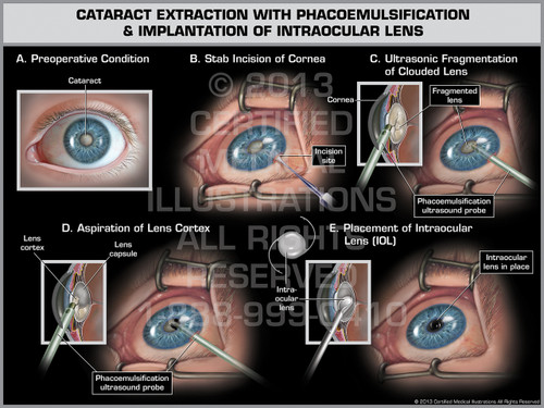 Cataract Extraction With Phacoemulsification