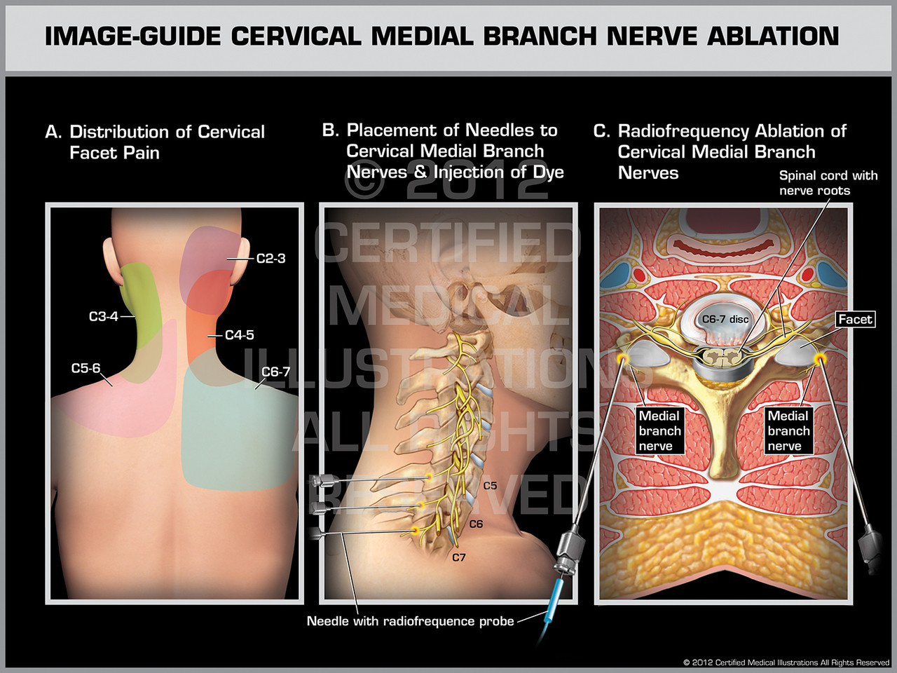 Image-Guide Cervical Medial Branch Nerve Ablation Female