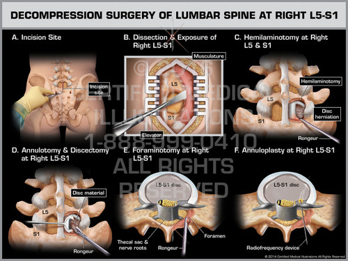 lumbar l5 s1