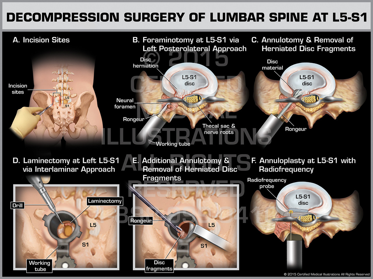 Surgery of Lumbar Spine at L5S1