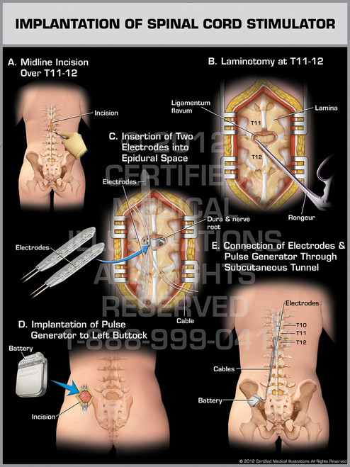 spinal cord stimulator surgery