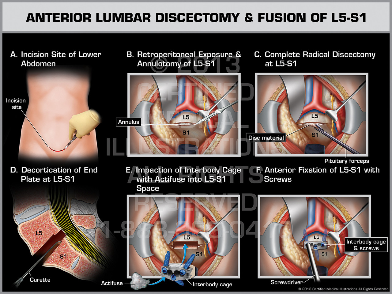 L5 s1 fusion surgery