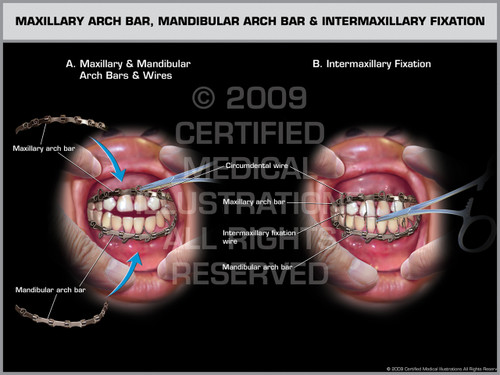 Maxillary Arch Bar, Mandibular Arch Bar and Intermaxillary ...