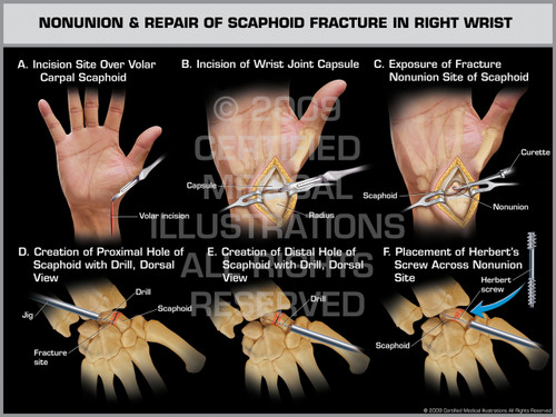 scaphoid fracture
