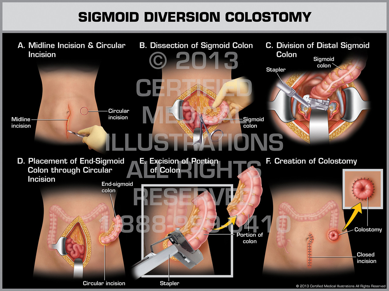 Sigmoid Diversion Colostomy (Female) ureter diagram female 