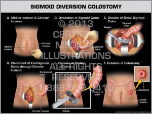 Loop Colostomy lower abdominal diagram male 