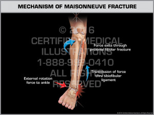 Mechanism of Whiplash Injury to Cervical Spine Male diagram of l4 l5 