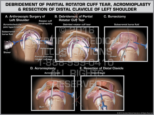 Debridement of Partial Rotator Cuff Tear, Acromioplasty