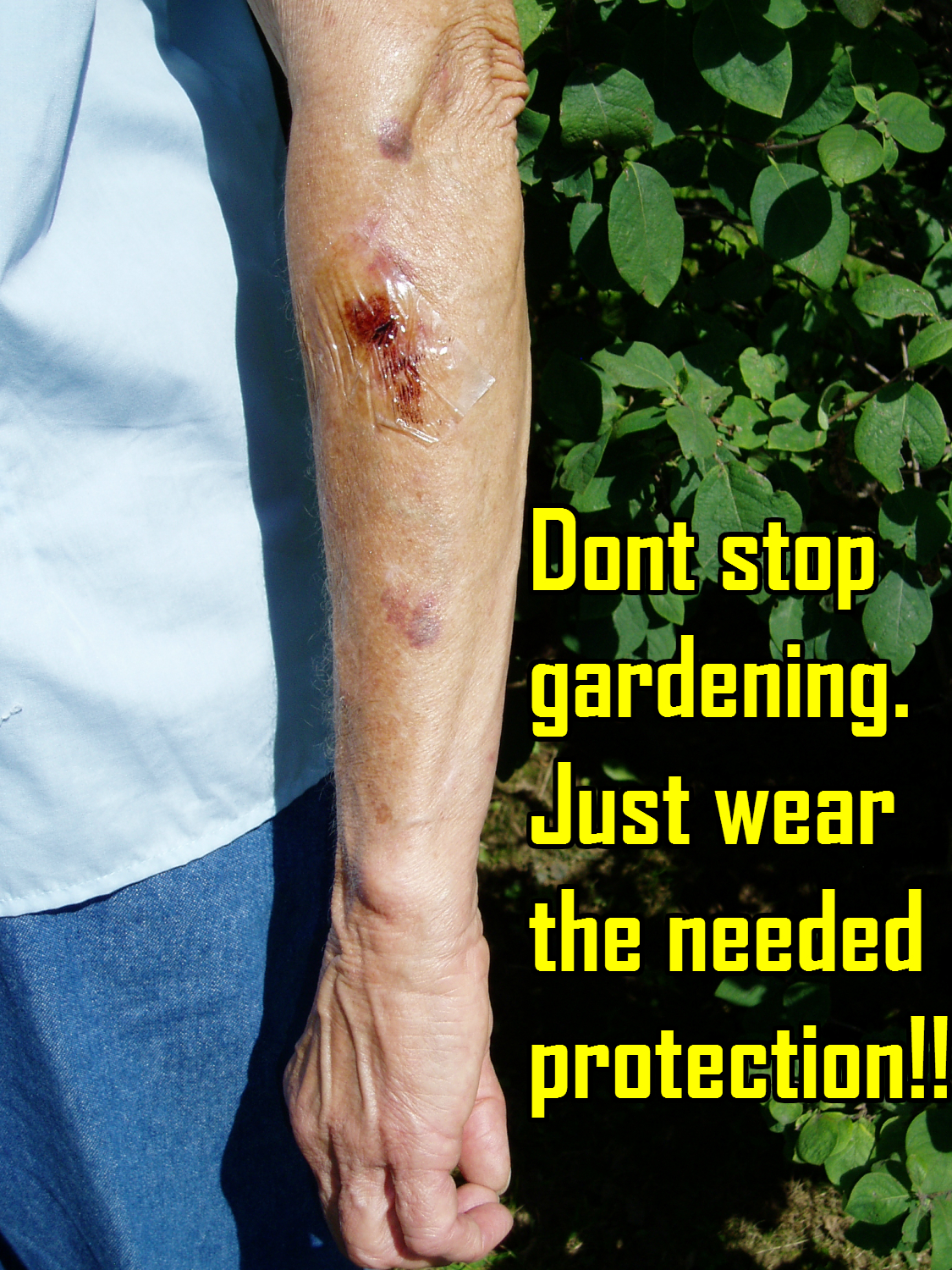 Bruising & Thin Skin Protection Arm Chaps