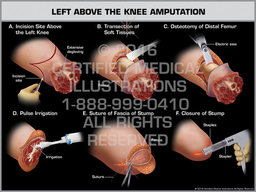 icd 10 imuscle sprain mid thoracic