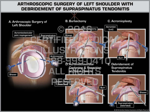 weightlifting after shoulder achroma plasty