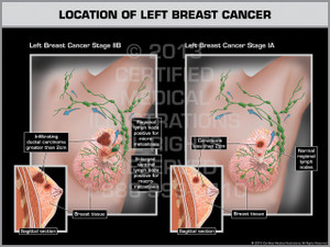 Location of Right Metastatic Breast Cancer & Enlarged Axillary
