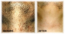 Before and after treatment with Priva Shave post hair removal  solution