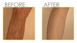 Hair No More Hair Growth Inhibitor Spray By Skin Doctors