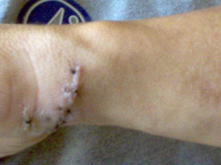 arm-chaps-wrist-stiches.jpg arm-chaps-wrist-stiches.jpg